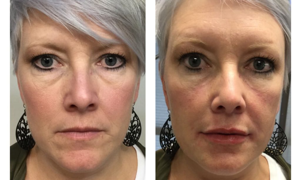 Before and after Volbella
