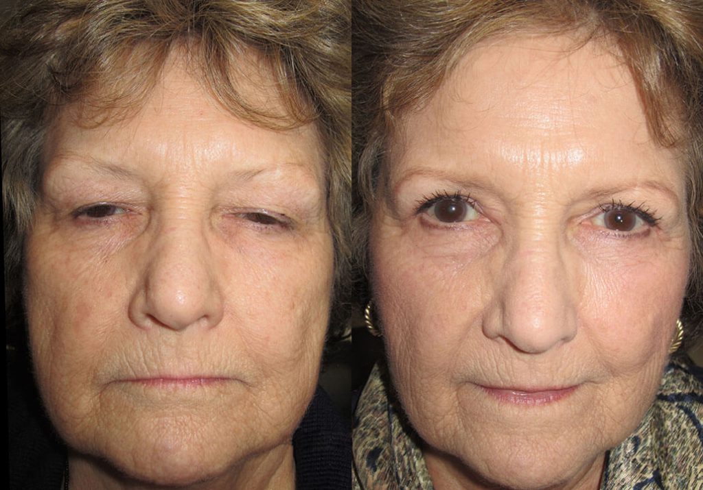 Before and after Blepharoplasty