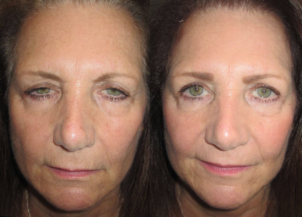 Before and after Blepharoplasty