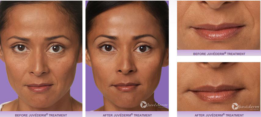 Before and after Juvederm