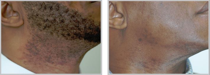 Before after Laser Hair Removal